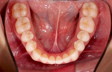 intra-oclusal-inferior-min-2