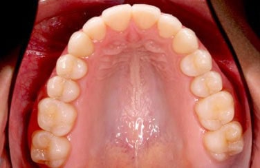 intra-oclusal-superior-min-2