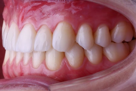 intraoral-esquerda-min