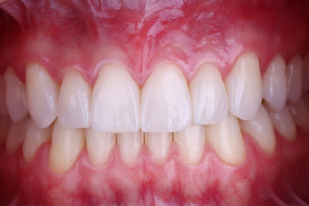 intraoral-frontal-min-1